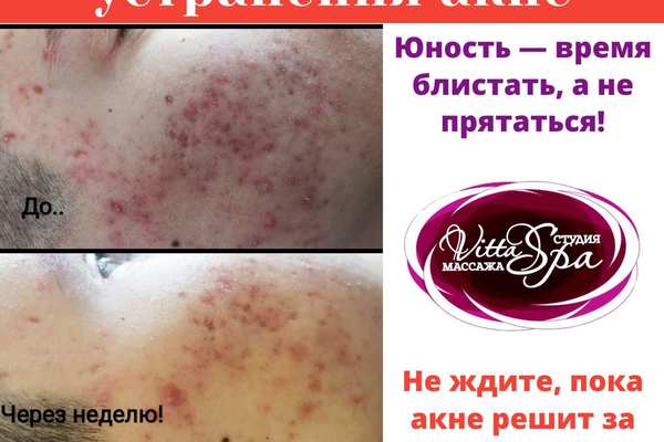 Авторская методика устранения акне
