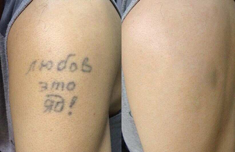 Как удалить татуировку?